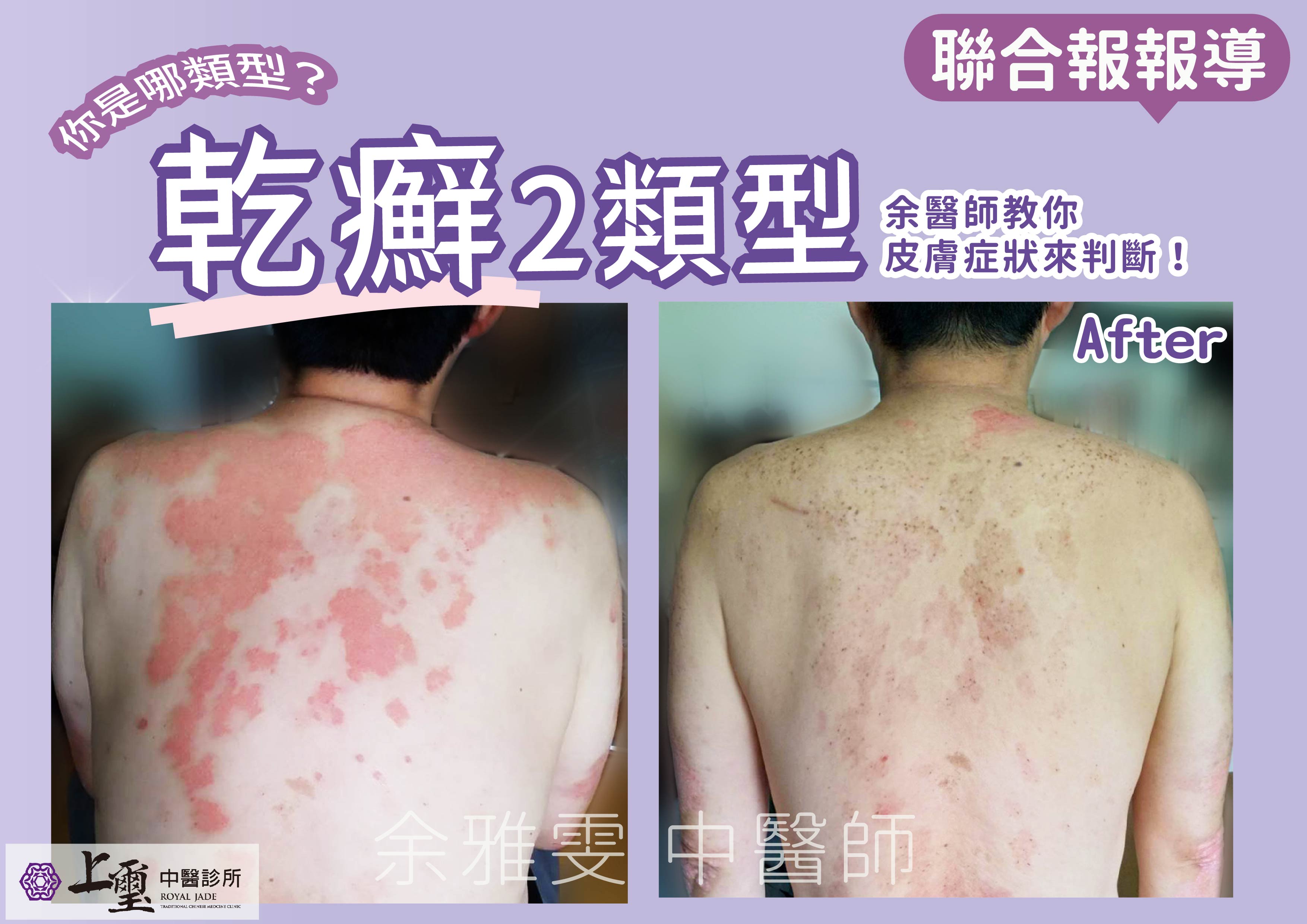 【新聞報導】天冷容易皮膚癢、紅腫斑塊、脫屑?當心乾癬發作 — 上璽中醫診所